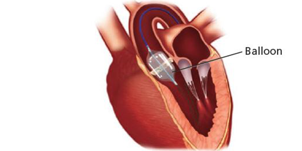 Pacemaker Implantation