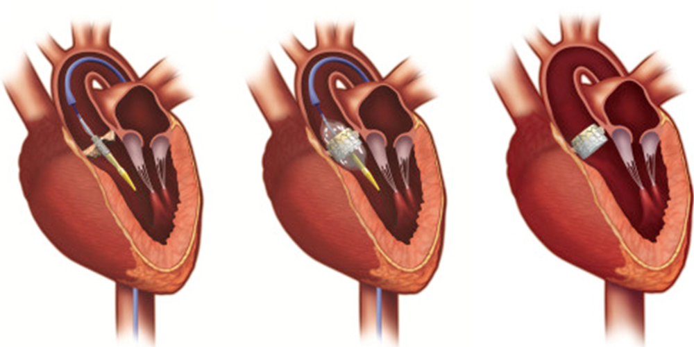 TAVR